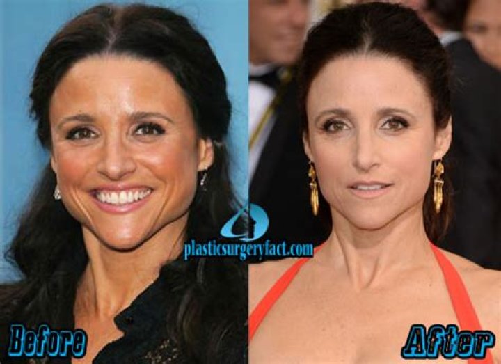 Julia Louis-Dreyfus Nose Job Plastic Surgery Before and After